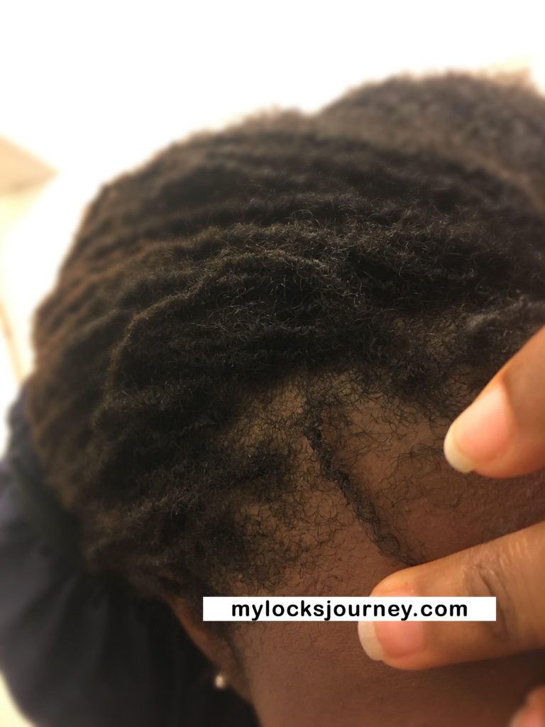 How to fix thinning edges My Locks Journey